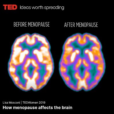 Így hat a menopauza a nők agyára